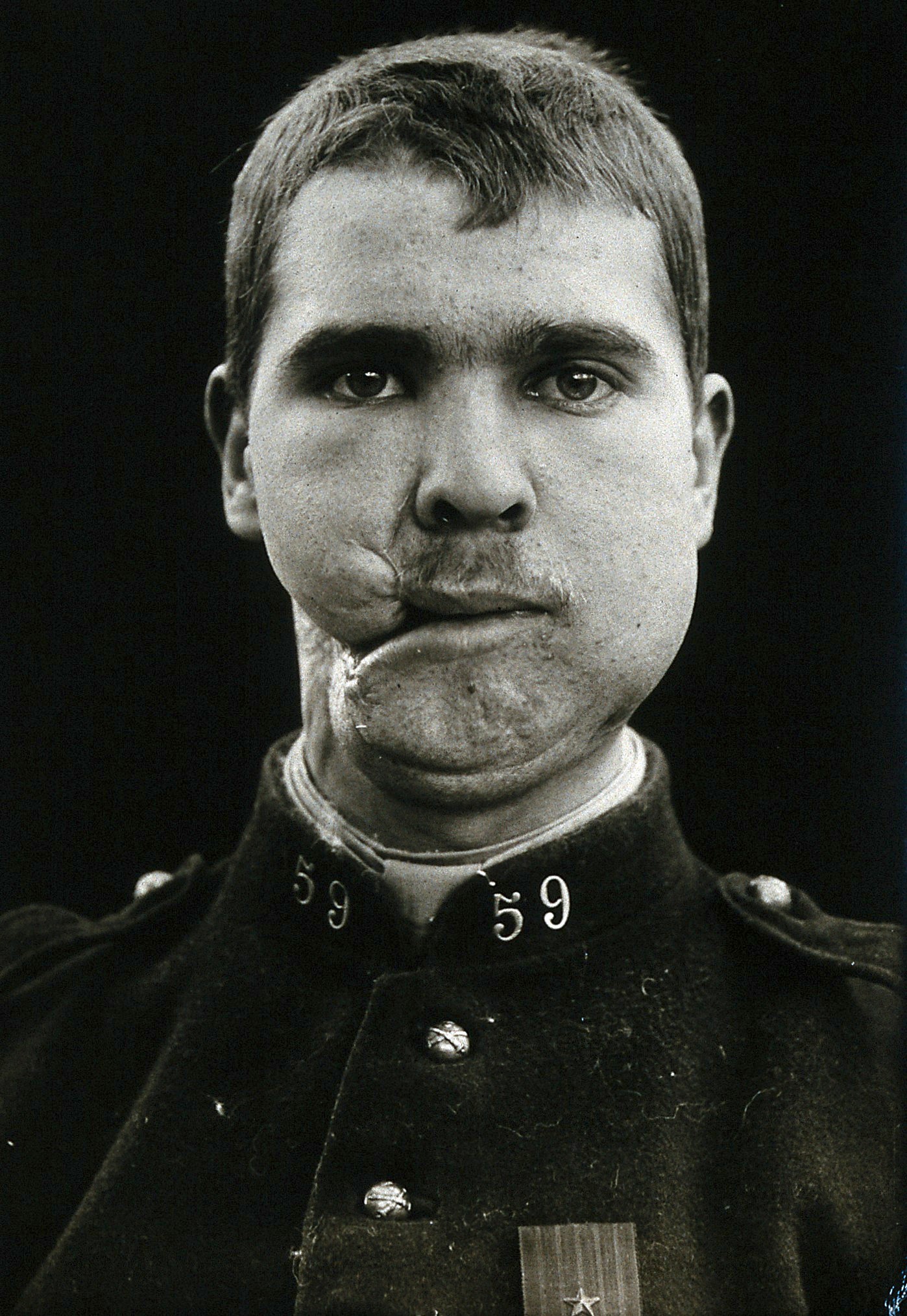 'Cranio-facial injury: a French soldier after incomplete plastic surgery to the lower face and neck. Photograph, 1916.' . Credit: https://wellcomecollection.org/works/m3dvuz2y  | https://creativecommons.org/licenses/by/4.0/