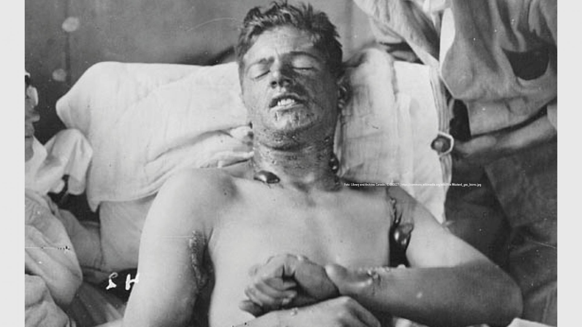  Canadese soldaat met blaren door mosterdgas  Foto: Library and Archives Canada / C-080027 ( https://commons.wikimedia.org/wiki/File:Mustard_gas_burns.jpg).