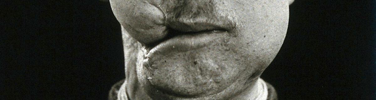 'Cranio-facial injury: a French soldier after incomplete plastic surgery to the lower face and neck. Photograph, 1916.' . Credit: https://wellcomecollection.org/works/m3dvuz2y  | https://creativecommons.org/licenses/by/4.0/