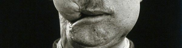 'Cranio-facial injury: a French soldier after incomplete plastic surgery to the lower face and neck. Photograph, 1916.' . Credit: https://wellcomecollection.org/works/m3dvuz2y  | https://creativecommons.org/licenses/by/4.0/