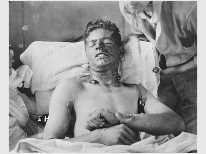 Canadese soldaat met blaren door mosterdgas| Foto: Library and Archives Canada / C-080027 ( https://commons.wikimedia.org/wiki/File:Mustard_gas_burns.jpg